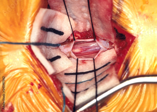 Tethered spinal cord repair