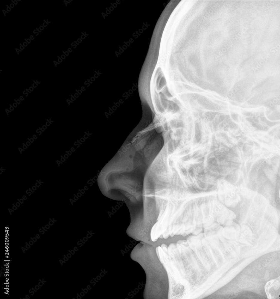 X Ray Of A Fracture Of The Nose Foto De Stock Adobe Stock