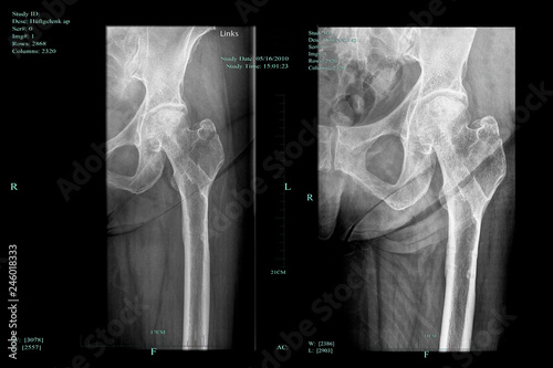 Femoral head necrosis and progress of the healing process of greater trochanter fracture photo