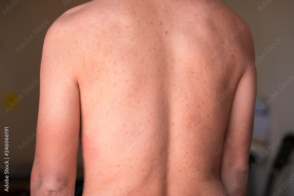 Concepts health problems, , skin diseases, a man showing his back with red spots, acne Concepts health problems, , skin diseases, a man showing his back with red spots, acne