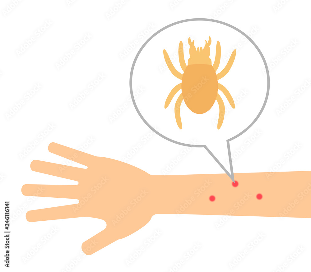 ダニさされ Stock イラスト Adobe Stock ダニさされ Stock イラスト Adobe Stock