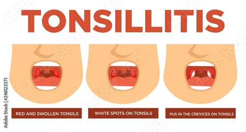 Tonsillitis red and swollen tonsils white spots