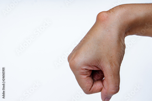 Ganglion cyst on woman hand on white background photo