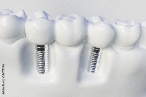 Fototapeta Naklejka Na Ścianę i Meble -  Tooth human implant - 3D Rendering