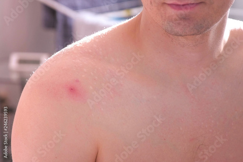 Big red pimple on a man s shoulder close-up view.