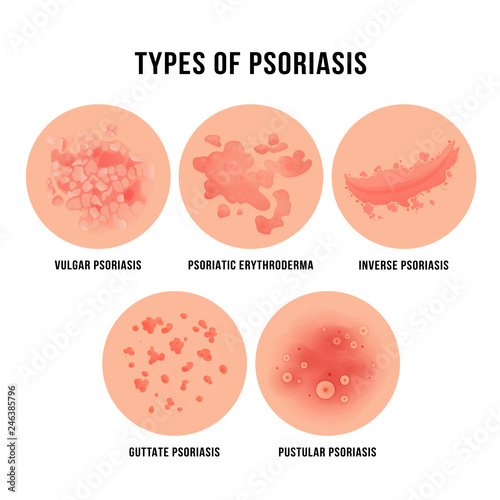 Psoriasis skin disease, types of derma problem photo