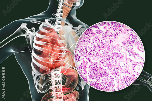 Lobar pneumonia, grey hepatic phase, 3D illustration and light micrograph, photo under microscope photo