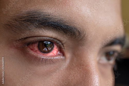 Принти на полотні irritated red eyes need sterile eye drops