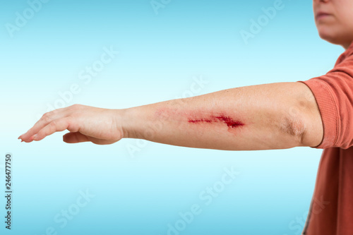 Fényképezés abrasion on a womans arm