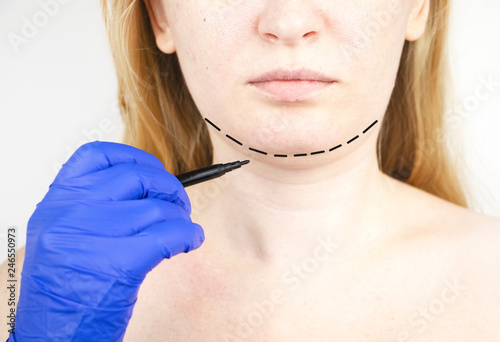 Mentoplasty: plastic chin. Patient before chin and neck surgery. Plastic surgeon advises photo