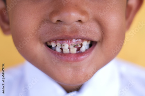 Child with baby tooth with cavities.