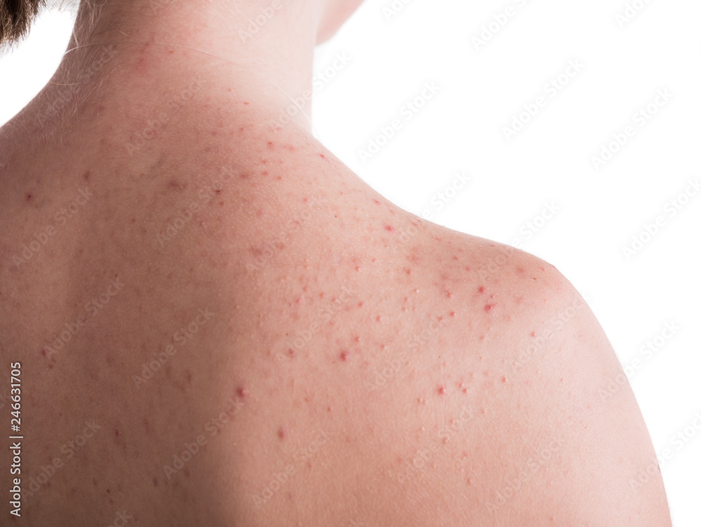 Teen girl with problematic skin on the back posing on a white background