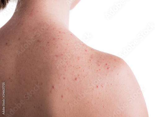 Obraz na płótnie Teen girl with problematic skin on the back posing on a white background w salonie