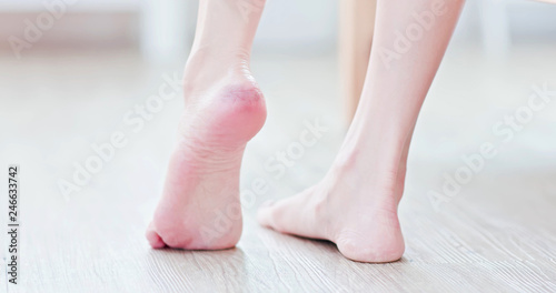 Woman with crack foot heel