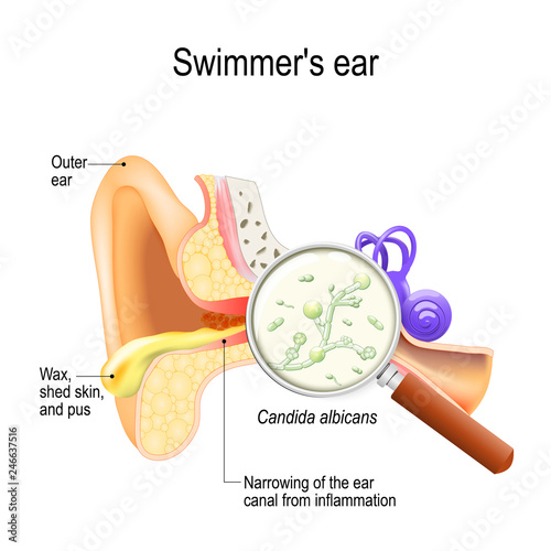 Otitis. swimmer's ear is inflammation of the ear canal and fungal infection that caused this disease. Candida albicans