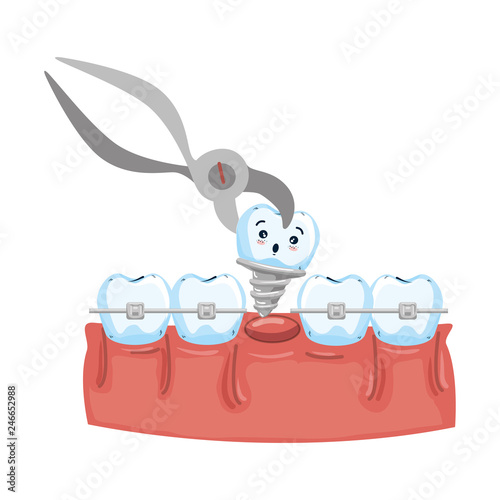 human teeth with pliers extracting implant