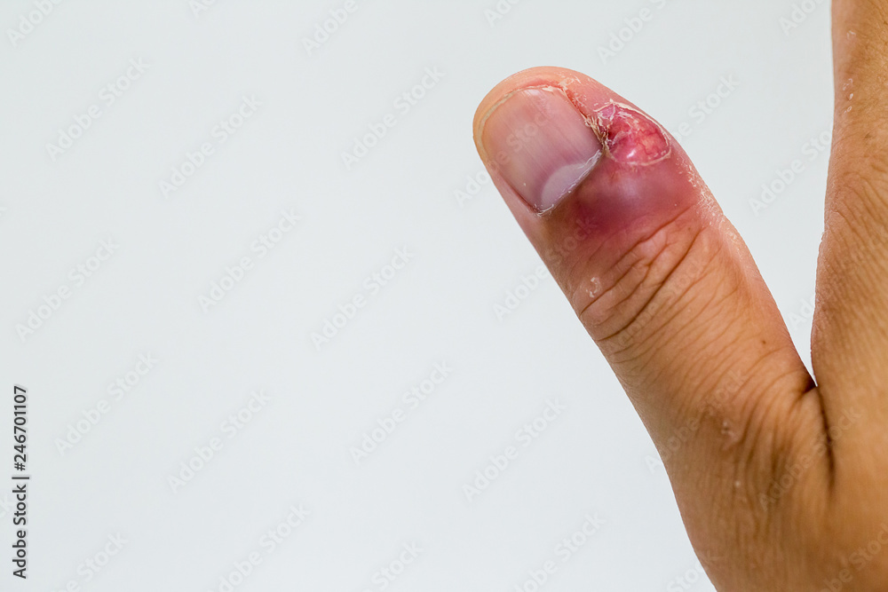 Paronychia Nail Infection - American Osteopathic College of Dermatology  (AOCD)