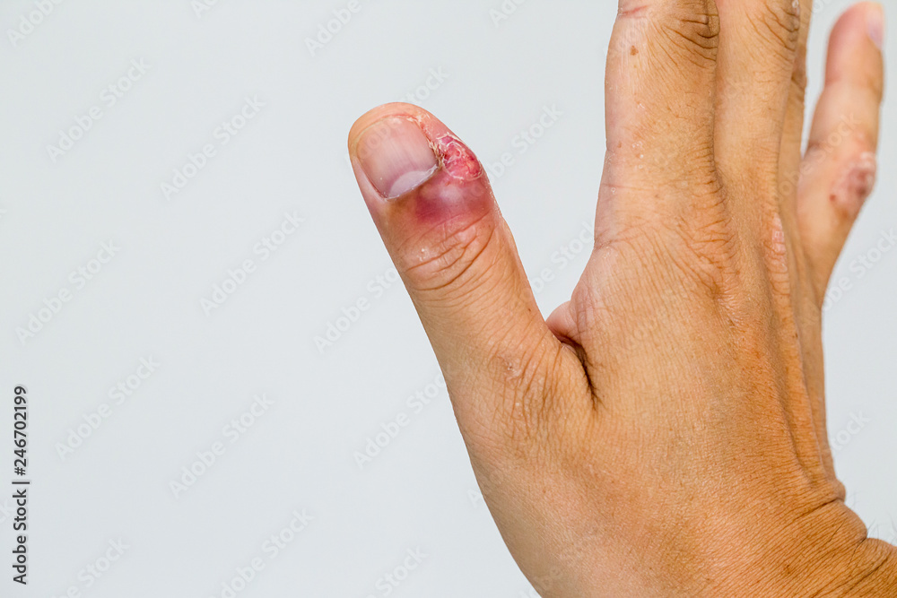Paronychia, swollen finger with fingernail bed inflammation due to bacterial infection on a