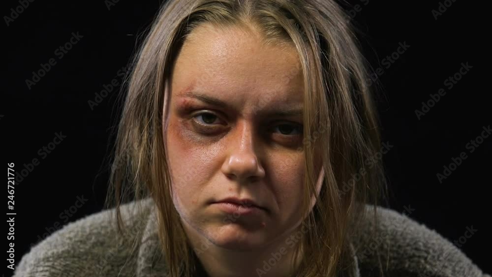 Bruised woman looking into camera with empty and indifferent look, family abuse Bruised woman looking into camera with empty and indifferent look, family abuse