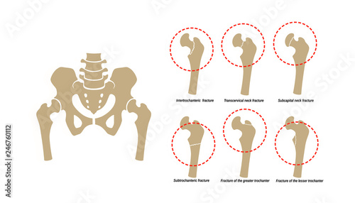 Εκτύπωση καμβά 6 Types of Femoral Neck Fracture