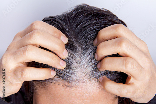 Young woman with white hair problem