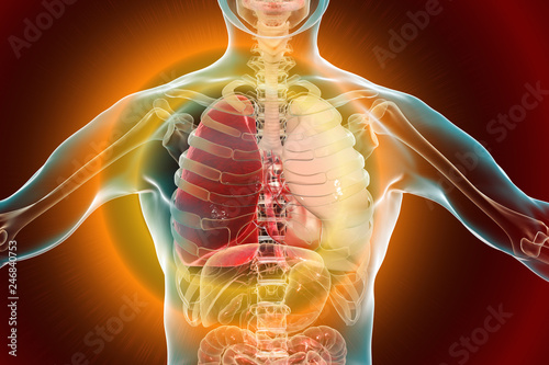 Pneumonia medical concept, 3D illustration showing lobar pneumonia of the right lung in the phase of grey hepatization