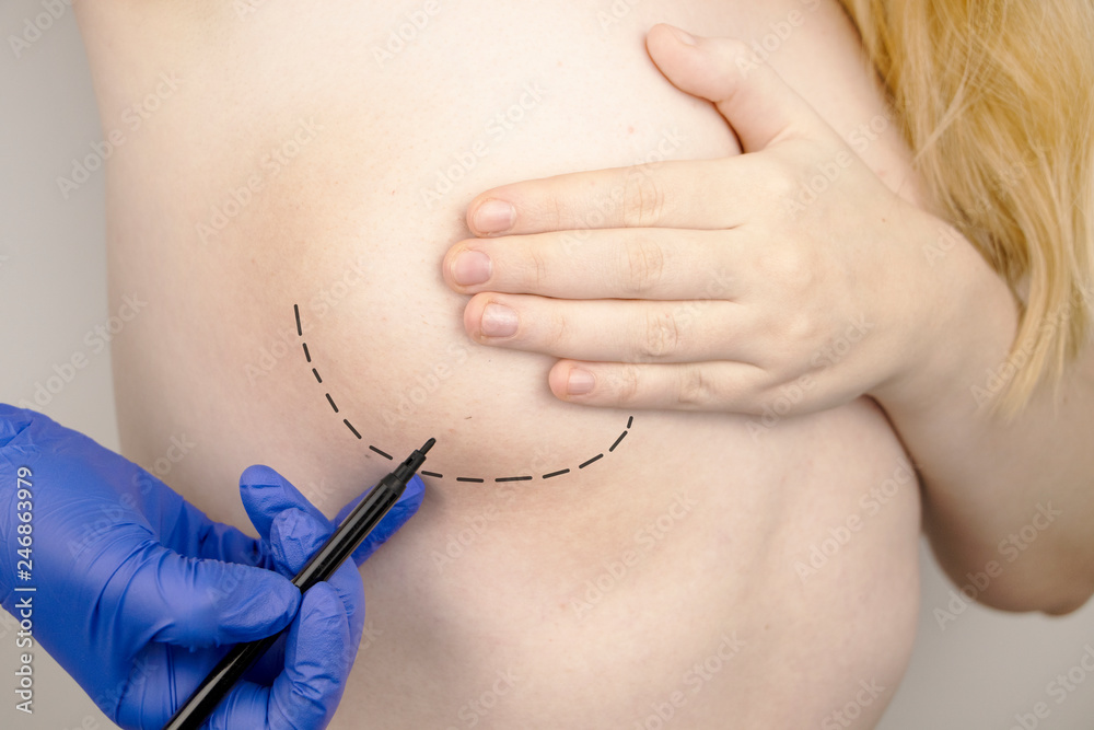 Breast plastic surgery - plastic breast augmentation surgery. The doctor prepares the patient for breast surgery
