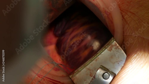 Closeup cardiovascular open heart surgery instruments in surgeon operation electrosurgery doctor in surgery center for interventions with thoracotomy microsurgery minimal invasive