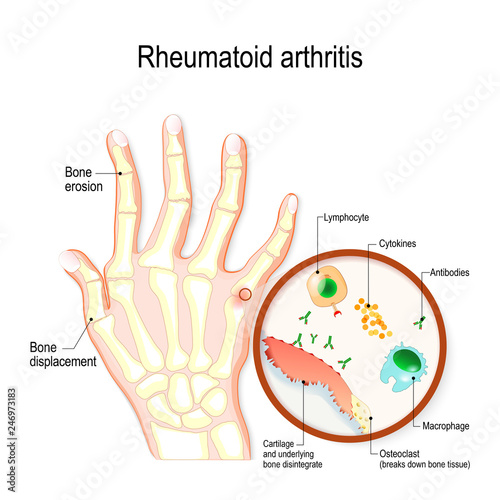 Rheumatoid Arthritis (RA) is an auto immune disease and inflammatory type of arthritis