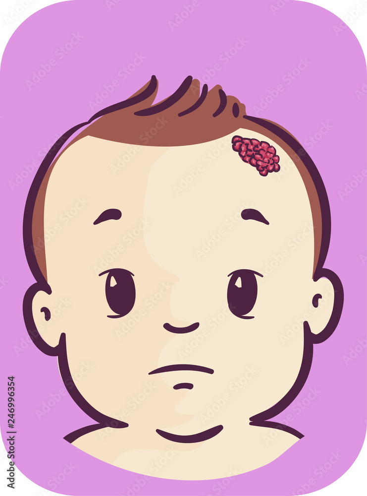 Baby Symptom Strawberry Nevus Illustration Stock Vector Adobe Stock