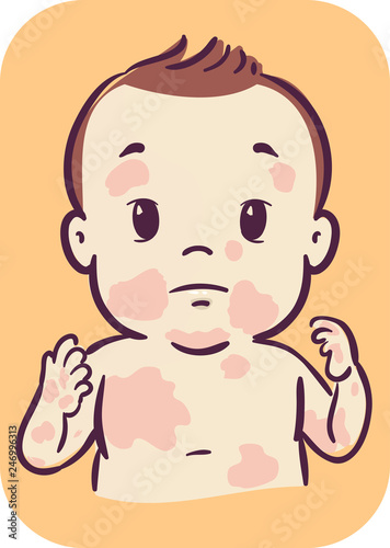 Baby Skin Rashes Illustration