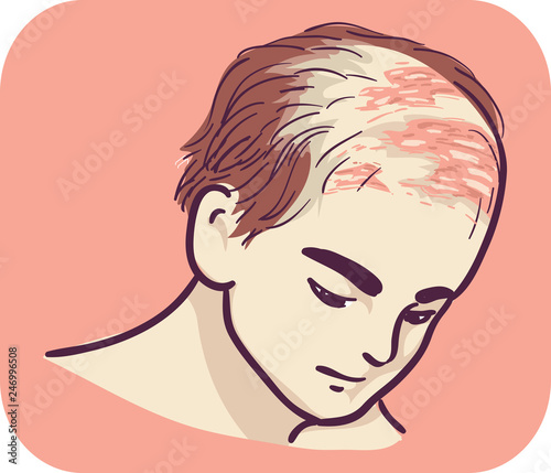 Man Symptom Scalp Blisterin...