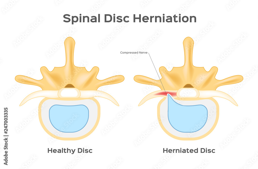 Back Disc Injuries Spinal disc herniation / human back infographic vector Stock Vector ...