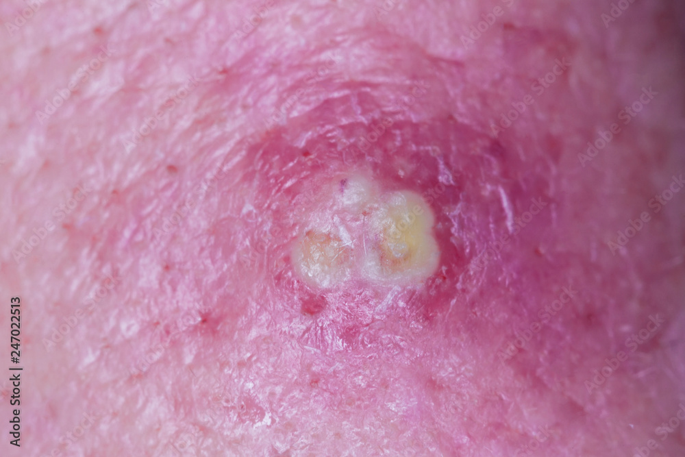 Fototapeta premium Purulent pimple on human skin