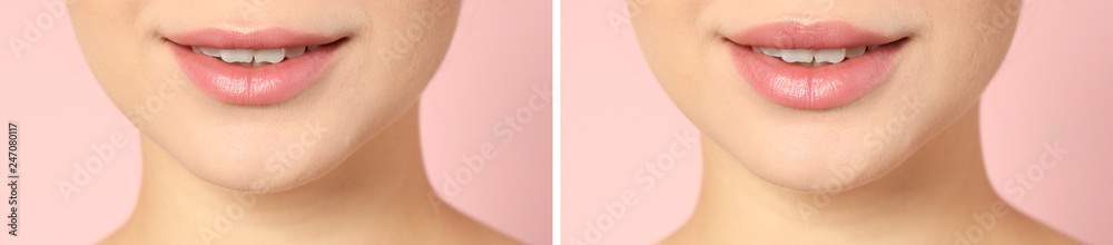 Fototapeta premium Woman before and after lips augmentation procedure on color background, closeup
