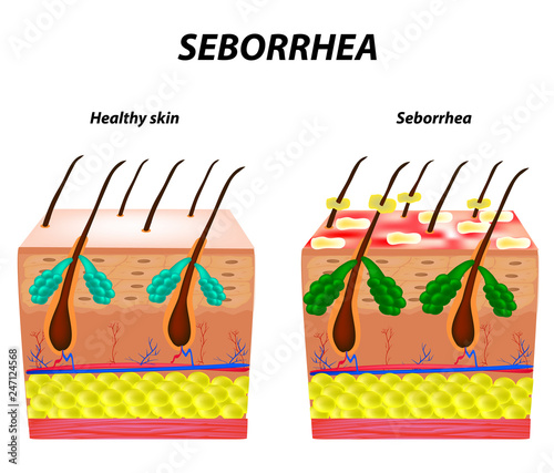 Seborrhea skin and hair. Dandruff seborrheic dermatitis. Eczema. Dysfunction of the sebaceous glands. Inflammatory skin disease. Anatomical structure. Infographics. Vector illustration.