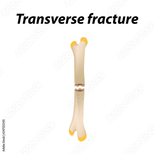 Transverse bone fracture. Infographics. Vector illustration on a lined background.