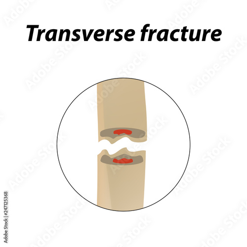 Transverse bone fracture. Infographics. Vector illustration on a lined background.