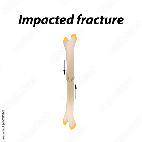 Impacted fracture Bone. Infographics. Vector illustration on a lined background.