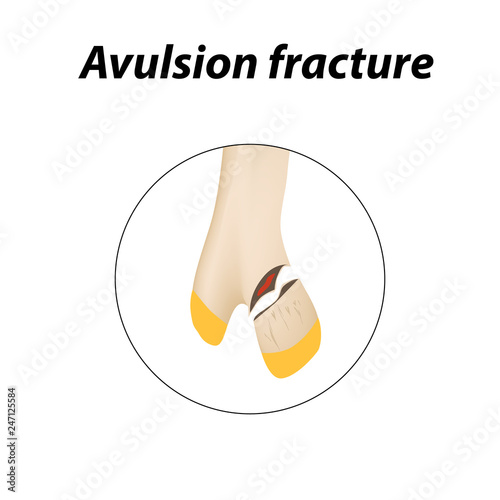Avulsion fracture Bone. Infographics. Vector illustration on a lined background.