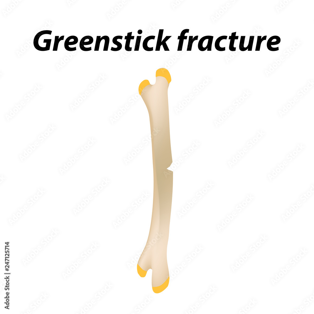 Greenstick Fracture