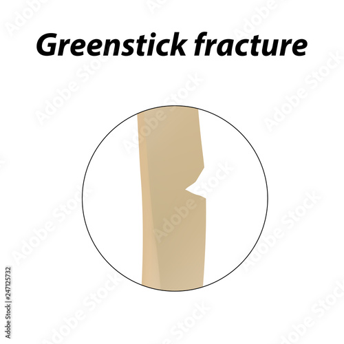 Greenstick fracture Bone. Infographics. Vector illustration on a lined background.