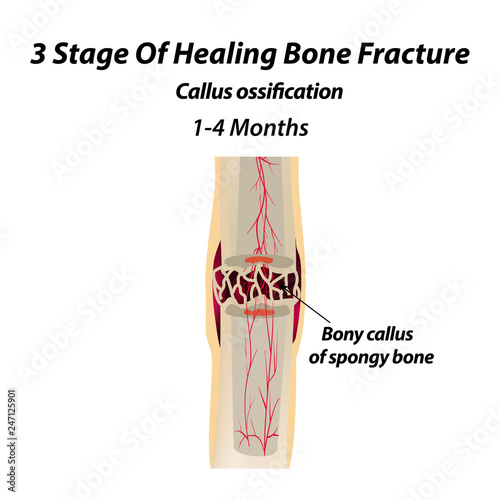 3 Stage Of Healing Bone Fracture. callus ossification. The bone fracture. Infographics. Vector illustration on isolated background.