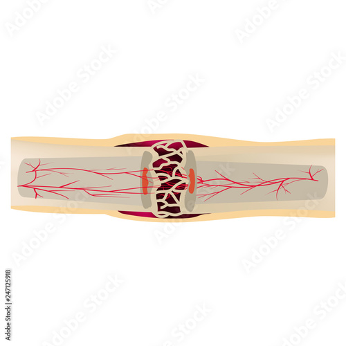 3 Stage Of Healing Bone Fracture. callus ossification. The bone fracture. Infographics. Vector illustration on isolated background.