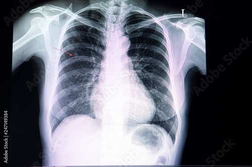 small nodule  in the lung
