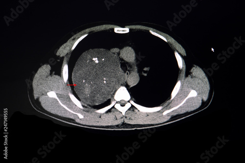CT scan of a chest showing anterior mediastinal tumor