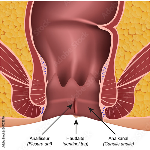 Anal Fissur Illustration mit Erklärung deutsch latain