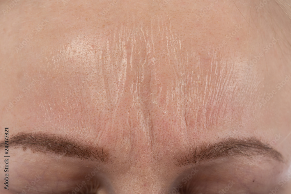 Fototapeta premium skin after peeling