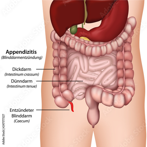 Blinddarmentzündung Appendizitis Illustration