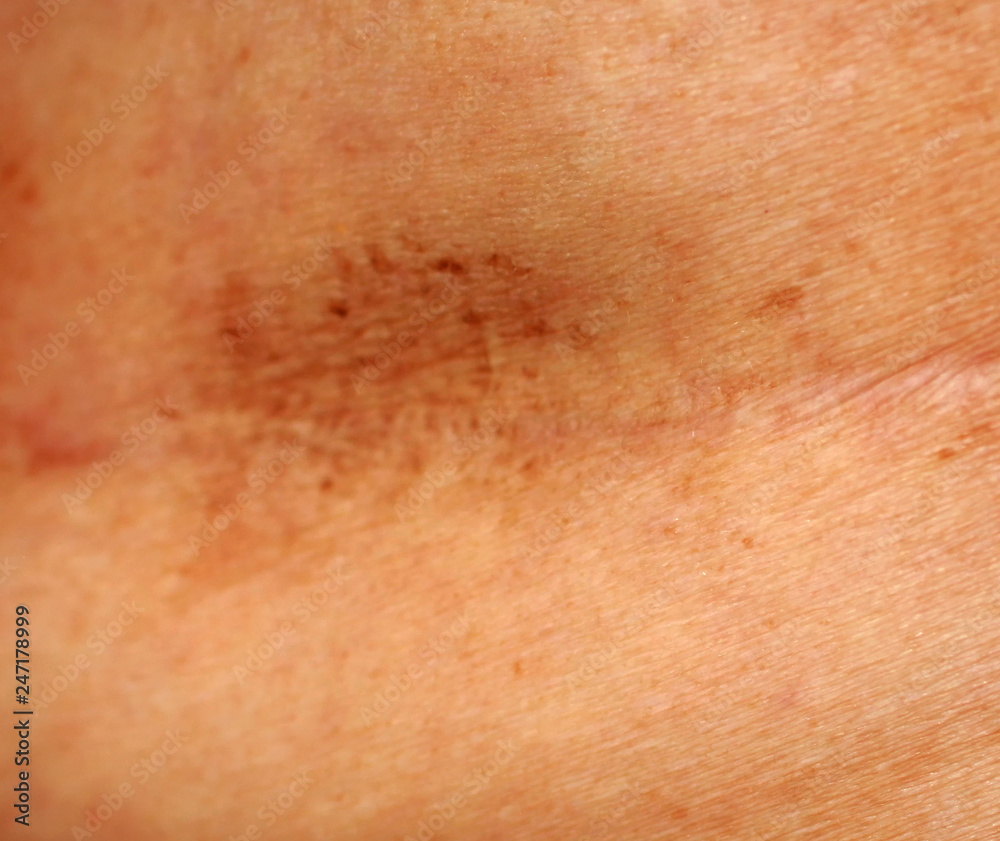 Scar on the breast after surgery. Brown spot